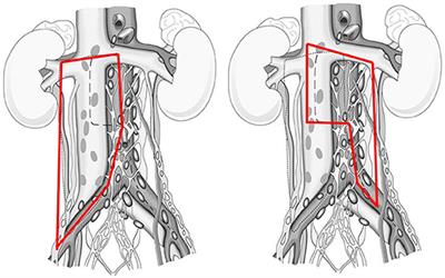 Preservation of Ejaculatory Function After Postchemotherapy Retroperitoneal Lymph Node Dissection (PC-RPLND) in Patients With Testicular Cancer: Template vs. Bilateral Resection